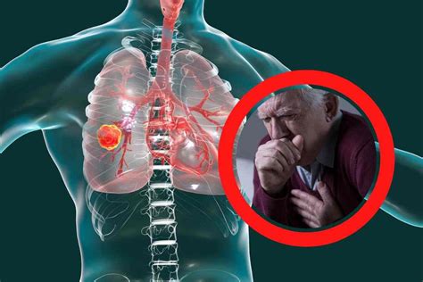 Sarcoidosi: malattia rara con sintomi ai polmoni e alla pelle